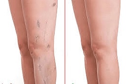 علاج الأوردة العنكبوتية – العلاج بالتصليب 8 علاج العروق العنكبوتية في أبوظبي قبل بعد
