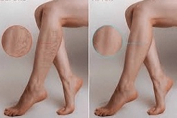 علاج العروق العنكبوتية في أبوظبي قبل وبعد