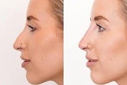 عملية الأنف غير الجراحية في أبو ظبي قبل وبعد