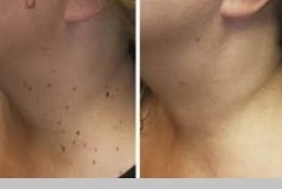 قبل وبعد إزالة الزوائد الجلدية في أبو ظبي