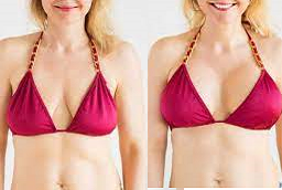 تصغير الثدي 6 قبل وبعد تصغير الثدي في أبوظبي