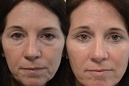 قبل وبعد جراحة الجفون في أبوظبي