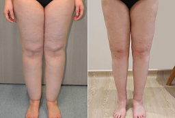 قبل وبعد شد الجزء السفلي من الجسم في أبو ظبي