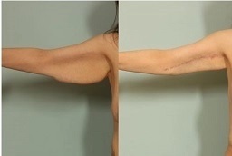 شد الذراعين 6 قبل وبعد شد الذراعين في أبو ظبي