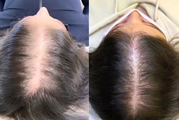 قبل وبعد علاج GFC للشعر في أبو ظبي