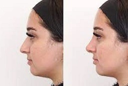 قبل وبعد عملية الأنف غير الجراحية في أبو ظبي