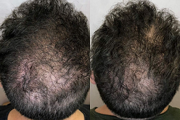 ACell PRP علاج لتساقط الشعر في أبو ظبي قبل بعد