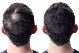 ACell PRP علاج لتساقط الشعر في أبو ظبي قبل وبعد