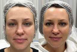 إندوليفت 8 إندوليفت في أبو ظبي قبل بعد