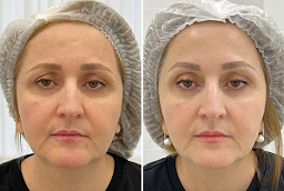 إندوليفت 7 إندوليفت في أبو ظبي قبل وبعد