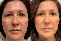 حشو المعابد في أبو ظبي قبل بعد