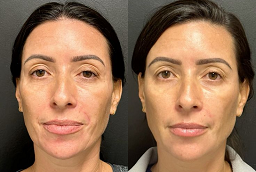 حشو المعابد في أبو ظبي قبل وبعد