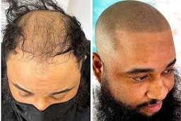 علاج الصلع للرجال 8 علاج الصلع للرجال في أبوظبي قبل بعد