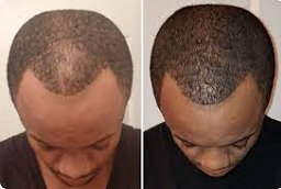 علاج الصلع للرجال 7 علاج الصلع للرجال في أبوظبي قبل وبعد