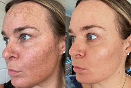 علاج الكلف في ابوظبي قبل وبعد