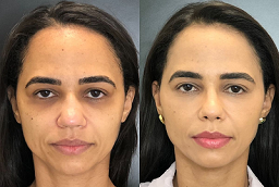 علاج الكولاجين للبشرة في أبو ظبي قبل بعد