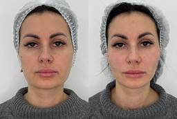 علاج الكولاجين للبشرة في أبو ظبي قبل وبعد