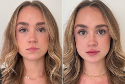 علاج شد البشرة 8 علاج شد البشرة في أبو ظبي قبل بعد