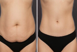 علاجات التخسيس 8 علاجات التخسيس في أبو ظبي قبل بعد