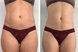 علاجات التخسيس 7 علاجات التخسيس في أبو ظبي قبل وبعد