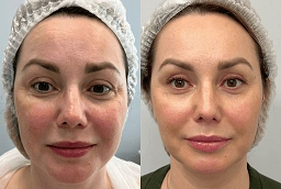 إندوليفت 6 قبل وبعد إندوليفت في أبو ظبي