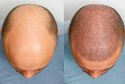 علاج الصلع للرجال 6 قبل وبعد علاج الصلع للرجال في أبوظبي