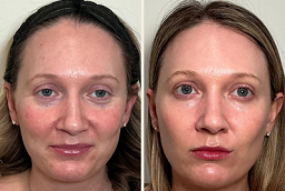 قبل وبعد علاج الكولاجين للبشرة في أبو ظبي