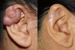 علاج الجدرة 8 علاج الجدرة في أبو ظبي قبل بعد