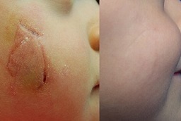 علاج الجدرة في أبو ظبي قبل وبعد