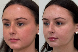 علاج بالترددات الراديوية 8 علاج بالترددات الراديوية في أبو ظبي قبل بعد