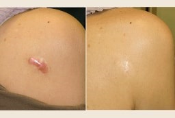 قبل وبعد علاج الجدرة في أبو ظبي