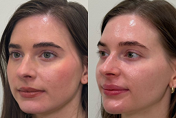 قبل وبعد علاج بالترددات الراديوية في أبو ظبي