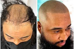 Baldness Treatment for Male 8 Baldnes Tretament for male