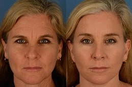 Forehead Lift Surgery 8 Before-After-Forehead-Lift-Surgery-in-Abu-Dhabi-Al-Ain