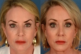 Before-After-Forehead-Lift-Surgery-in-Abu-Dhabi