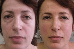 Stemcell Facelift Treatment 8 Before-After-Stem-Cell-Facelift-in-Abu-Dhabi-Al-Ain