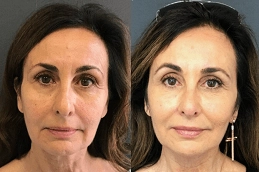 Before-After-Stem-Cell-Facelift-in-Abu-Dhabi