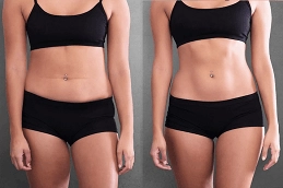 Waist Sculpting 6 Before-After-Waist-Sculpting-in-Abu-Dhabi-Al-Ain