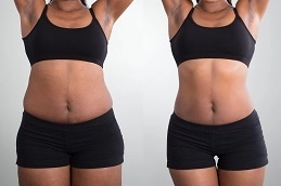 Waist Sculpting 8 Before-After-Waist-Sculpting-in-Abu-Dhabi