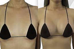 How To Increase Boob Size With Breast Implant Surgery? - Dr Adnan