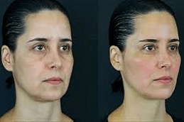 Hyaluronic Acid 4 Best-Clinic-for-Hyaluronic-Acid-Injections-in-Abu-Dhabi