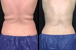CoolSculpting Fat Freezing 6 Best CoolSculpting Fat Freezing in Abu dhabi and UAE