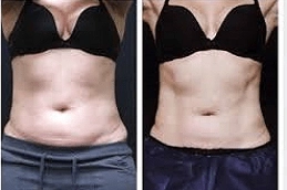 CoolSculpting Fat Freezing 7 Best CoolSculpting Fat Freezing in Abu dhabi