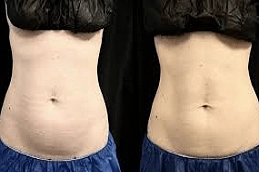 CoolSculpting Fat Freezing 8 Best CoolSculpting Fat Freezing