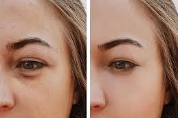 Best-Dark-Circle-Treatments-Clinic-in-Abu-Dhabi-Al-Ain