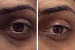 Best-Dark-Circle-Treatments-Clinic-in-Abu-Dhabi