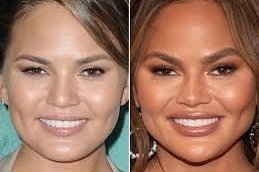 Eyebrow Hair Transplant 5 Best-Eyebrow-Hair-Transplant-Clinic-in-Abu-Dhabi.