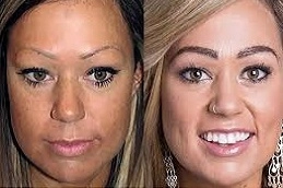 Best-Eyebrow-Hair-Transplant-in-Abu-Dhabi-Al-Ain