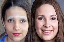 Best-Eyebrow-Hair-Transplant-in-Abu-Dhabi