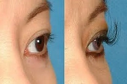 Best-Eyelash-Hair-Transplant-Clinic-in-Abu-Dhabi-Al-Ain
